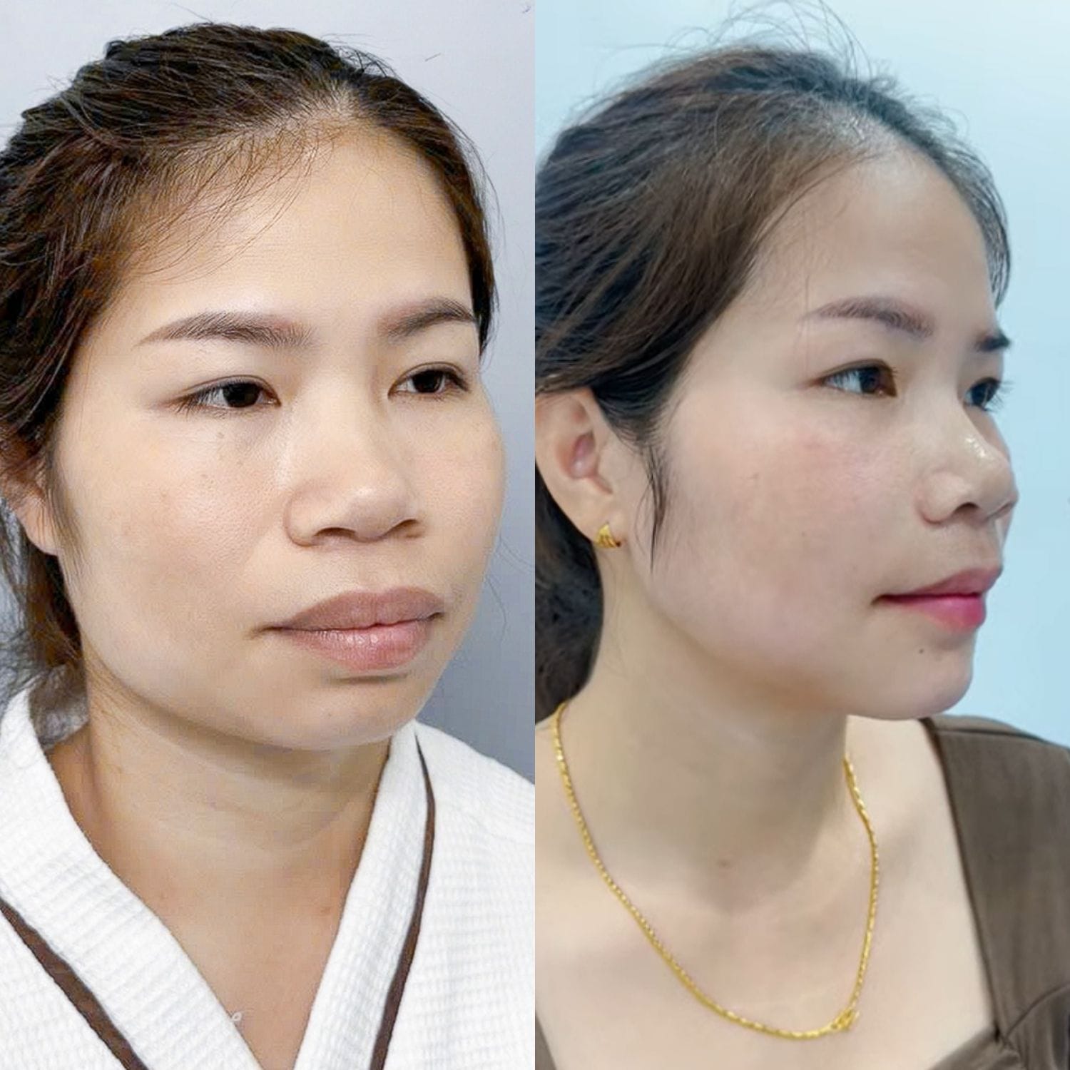 Trượt cằm V-line