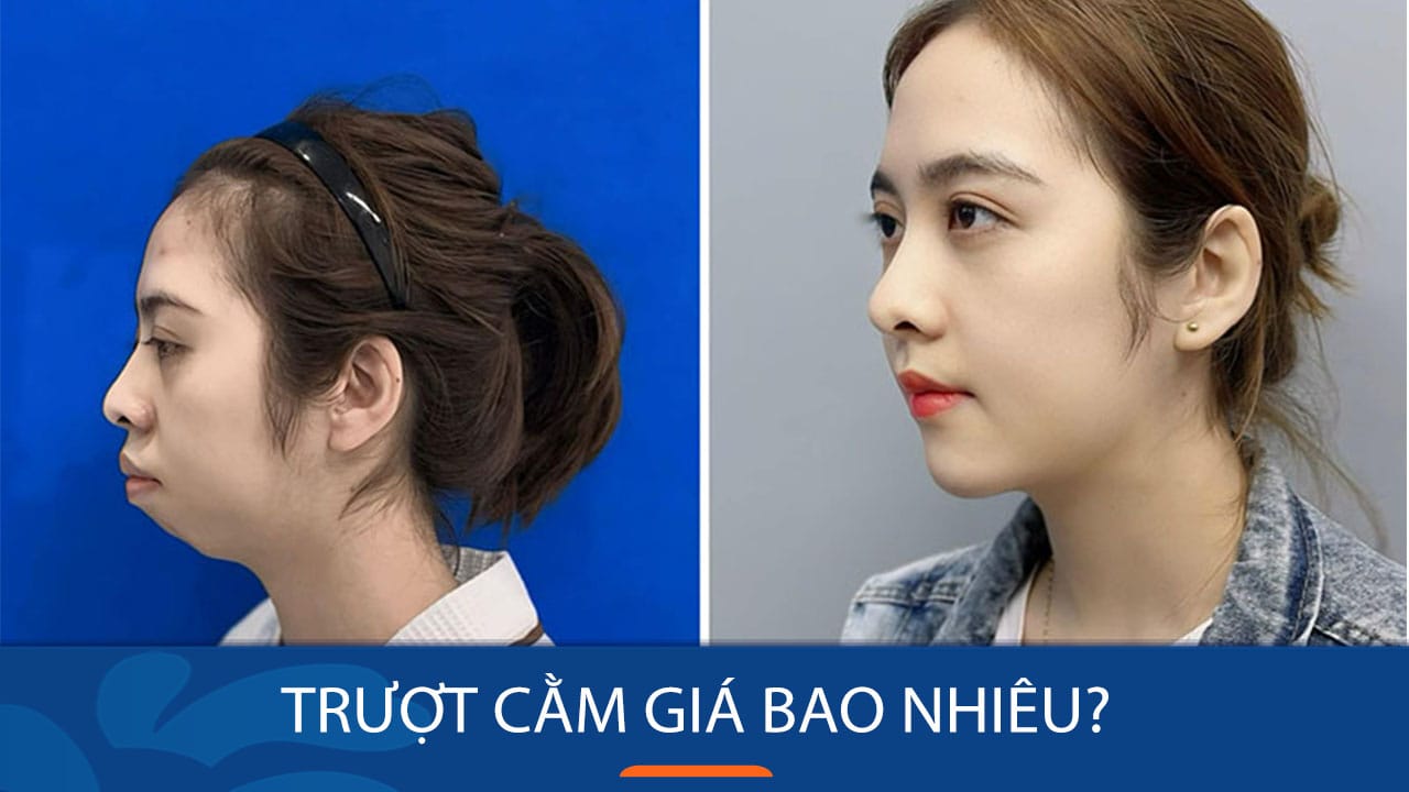Chi phí trượt cằm giá bao nhiêu? Có đắt không?