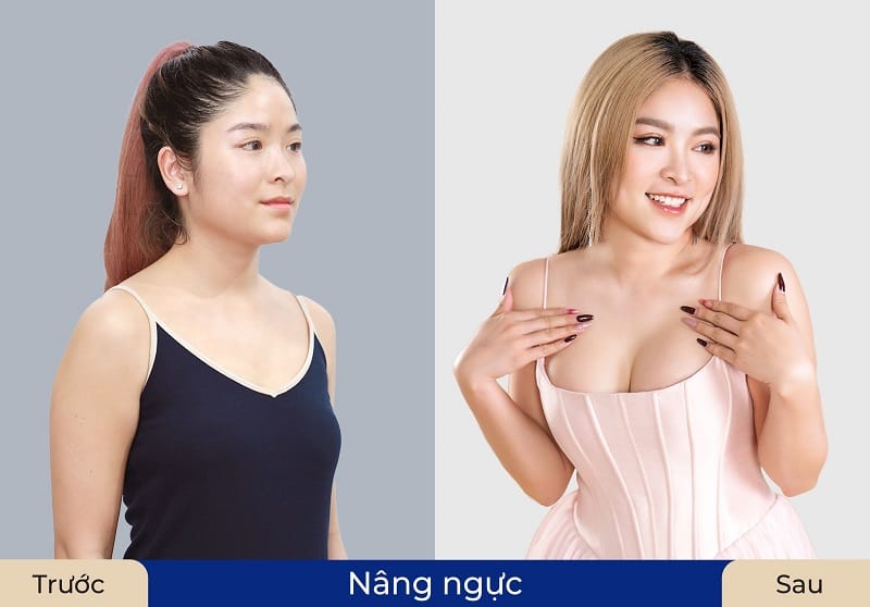 Lựa chọn nâng ngực tại thẩm mỹ uy tín, tránh ham rẻ có thể xảy ra biến chứng