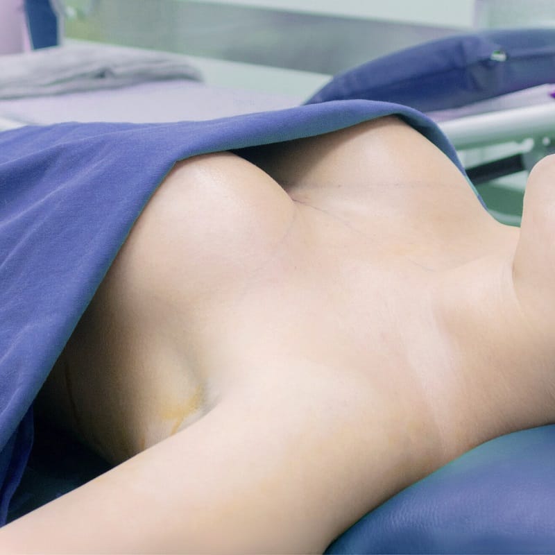 Phái đẹp nên thực hiện nâng ngực bằng túi độn chất lượng cao