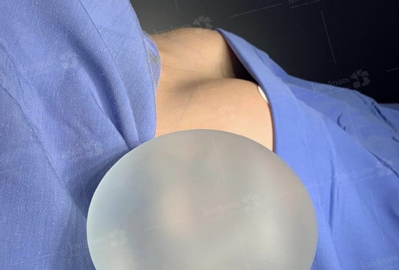 Túi ngực Nano Chip Ergonomix có giá cao hơn so với túi độn thông thường