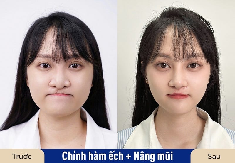 Phẫu thuật đúng kỹ thuật sẽ hạn chế để lại sẹo