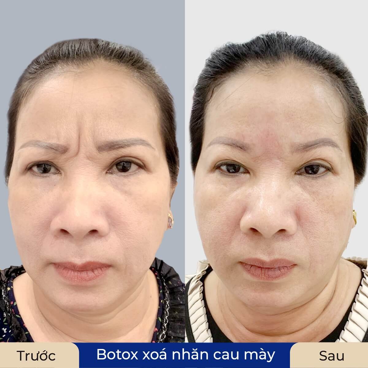 Tiêm Botox có thể xóa được nếp nhăn cau mày bằng cách đưa botulinum toxin vào vùng cơ gây nhăn