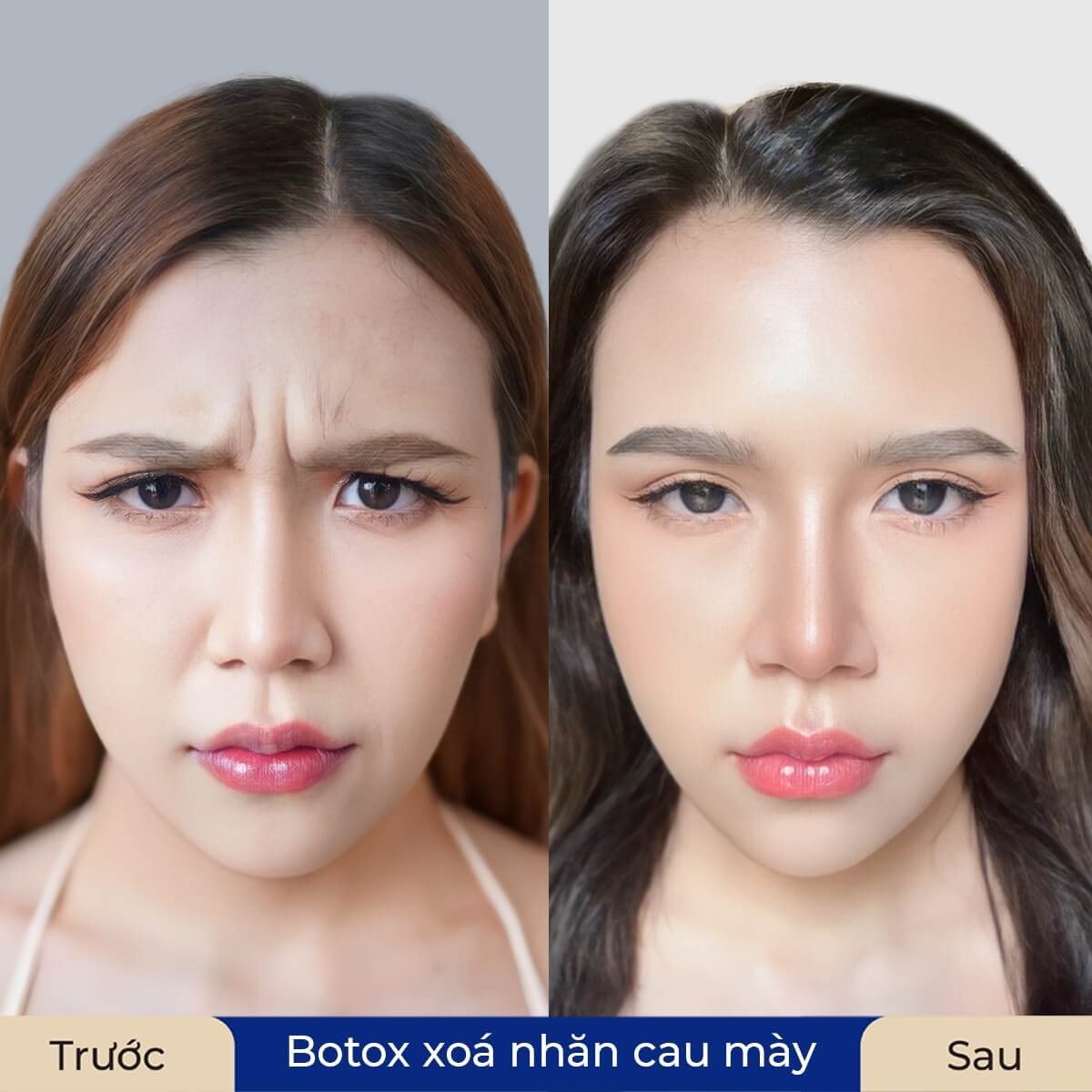 Tiêm Botox xóa nhăn cau mày không đau nếu thực hiện bởi bác sĩ chuyên khoa và sử dụng sản phẩm chính hãng