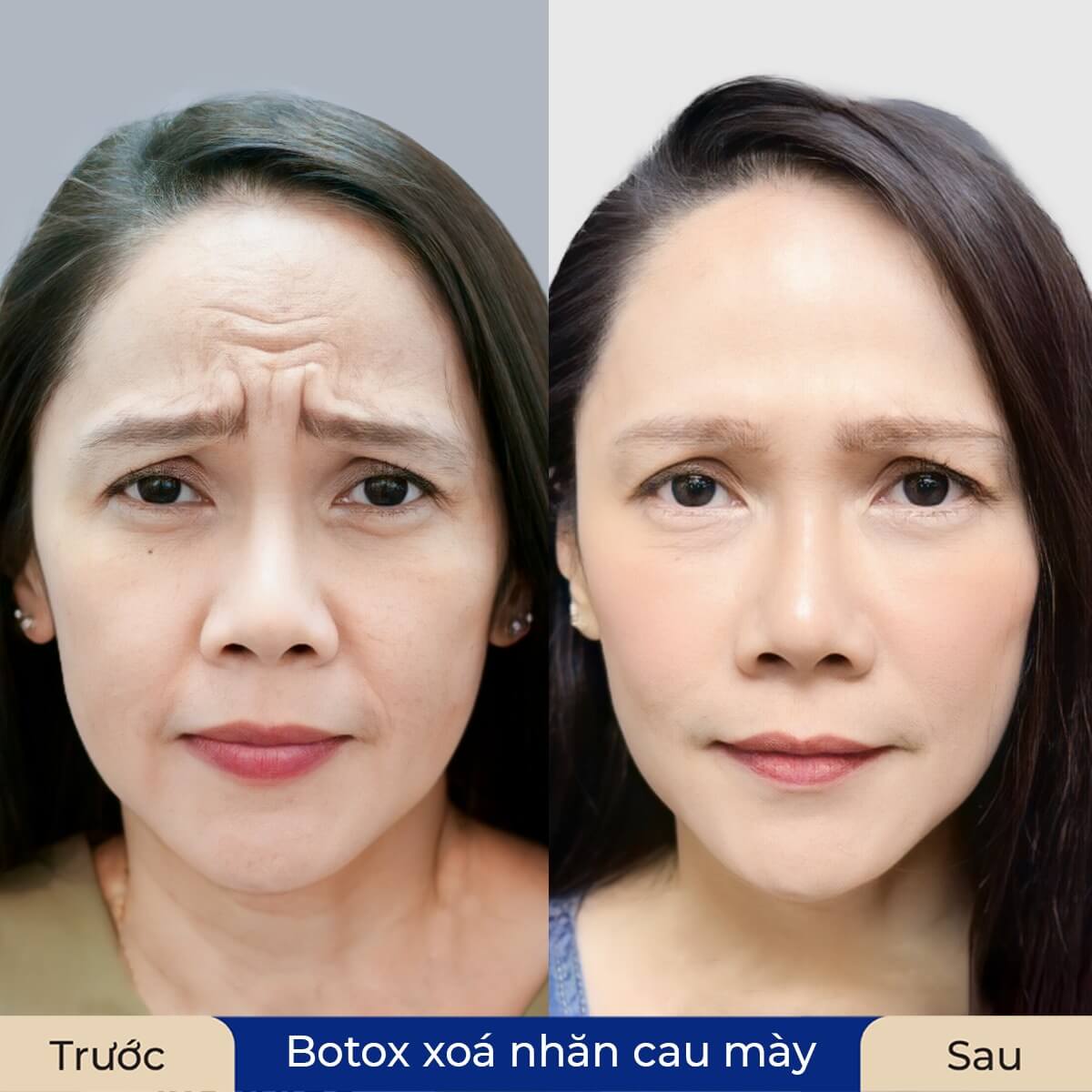 Nếp nhăn trán giảm rõ rệt sau liệu trình botox đúng kỹ thuật