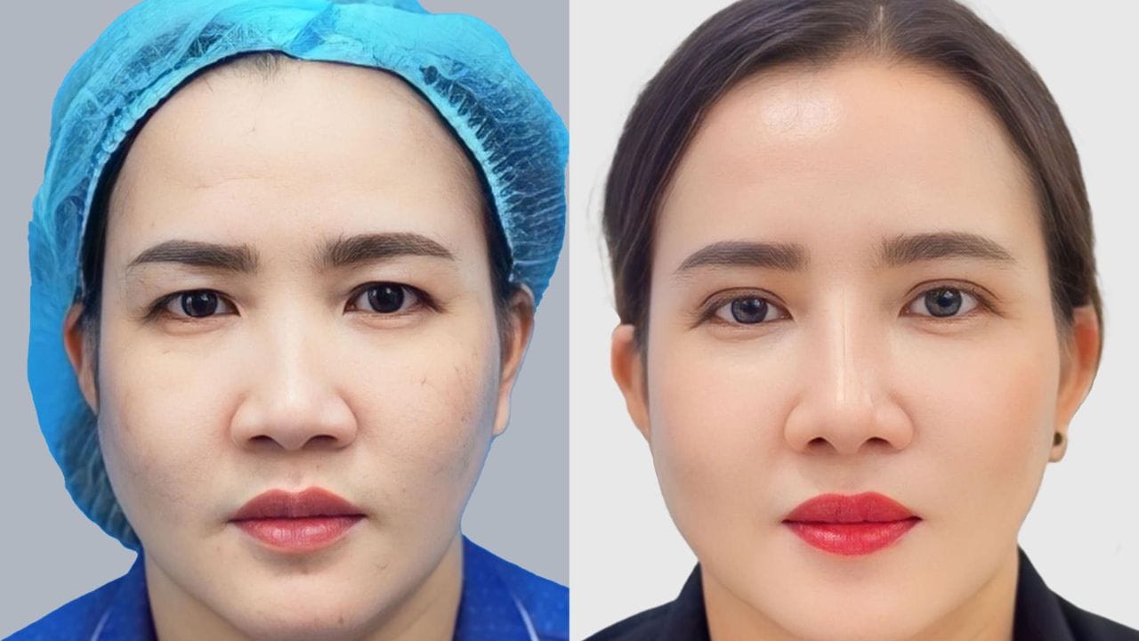 Cắt mắt sụp mí bao nhiêu tiền? Yếu tố ảnh hưởng đến chi phí