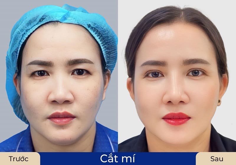 Chi phí cắt mí mắt bị sụp trên thị trường rất đa dạng