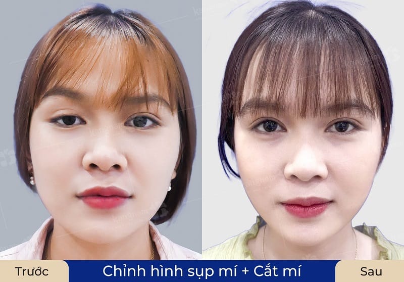 Chỉnh hình sụp mí giúp khách hàng sở hữu mí mắt cân đối, cải thiện tầm nhìn hiệu quả