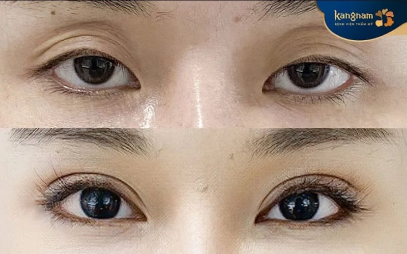 Vùng mí mắt có thể bị sưng tấy