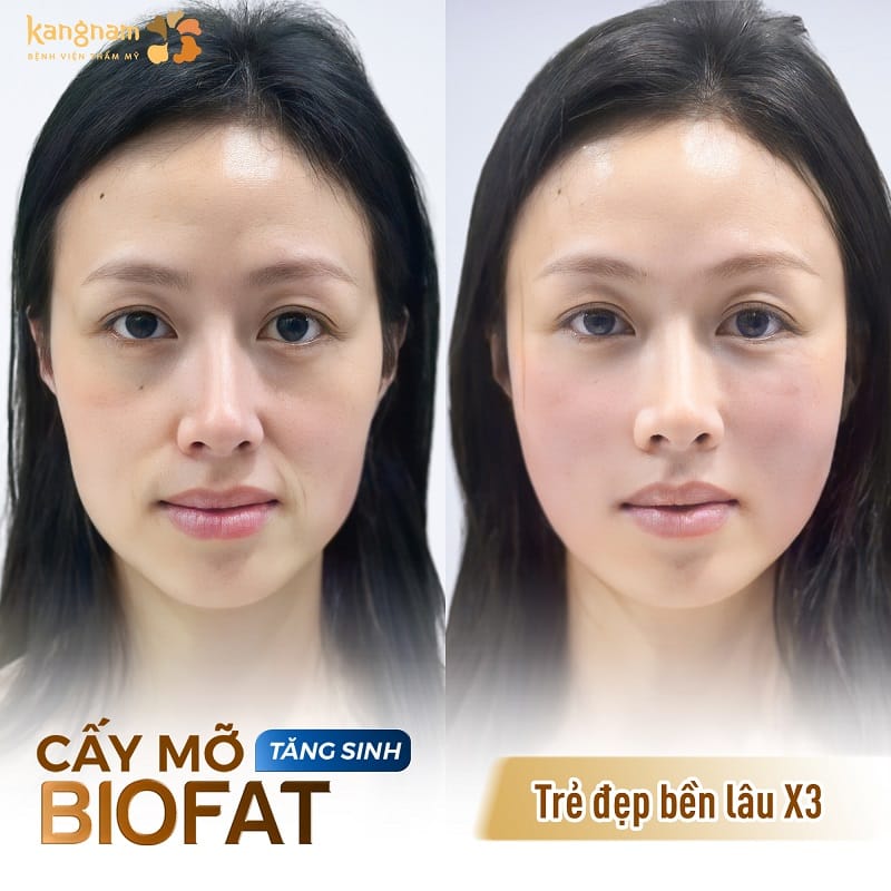 Kangnam ứng dụng công nghệ cấy mỡ hiện đại