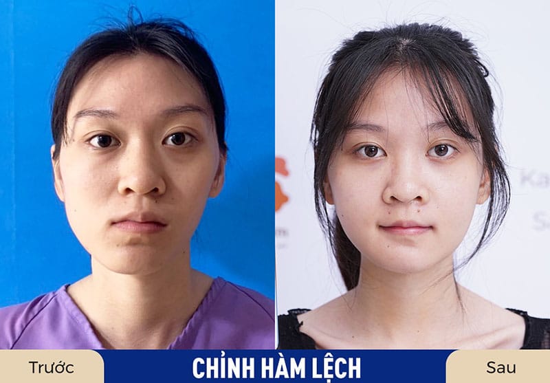 Gương mặt hài hòa hơn sau phẫu thuật chỉnh hàm lệch tại Kangnam