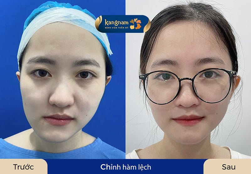 Khách hàng thay đổi rõ rệt về thẩm mỹ và chức năng sau chỉnh hàm