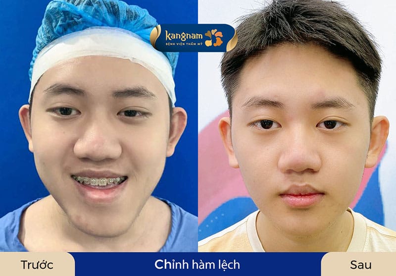 Khớp cắn cân đối, nụ cười tự tin nhờ can thiệp hàm mặt toàn diện