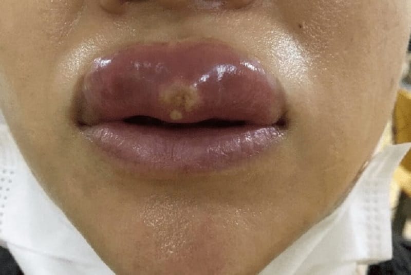 Môi bị hoại tử do kỹ thuật tiêm filler không đúng cách