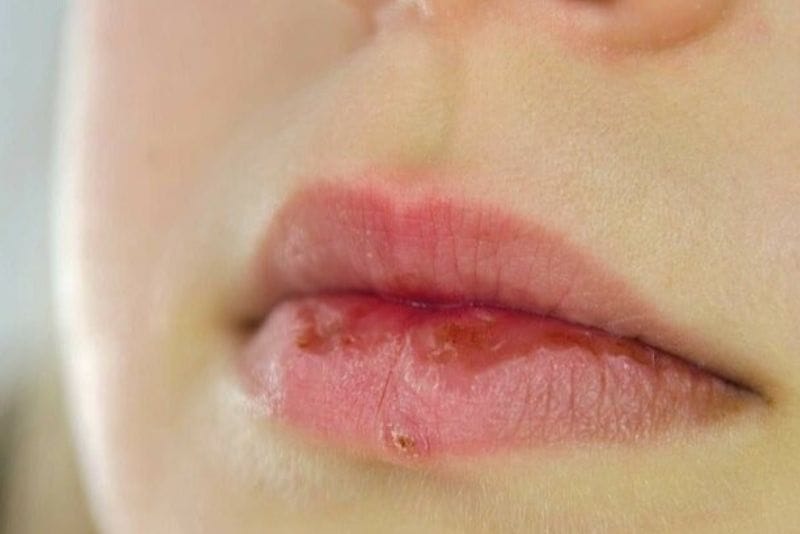 Dấu hiệu tiêm filler môi bị hoại tử là xuất hiện các dịch tiết bất thường