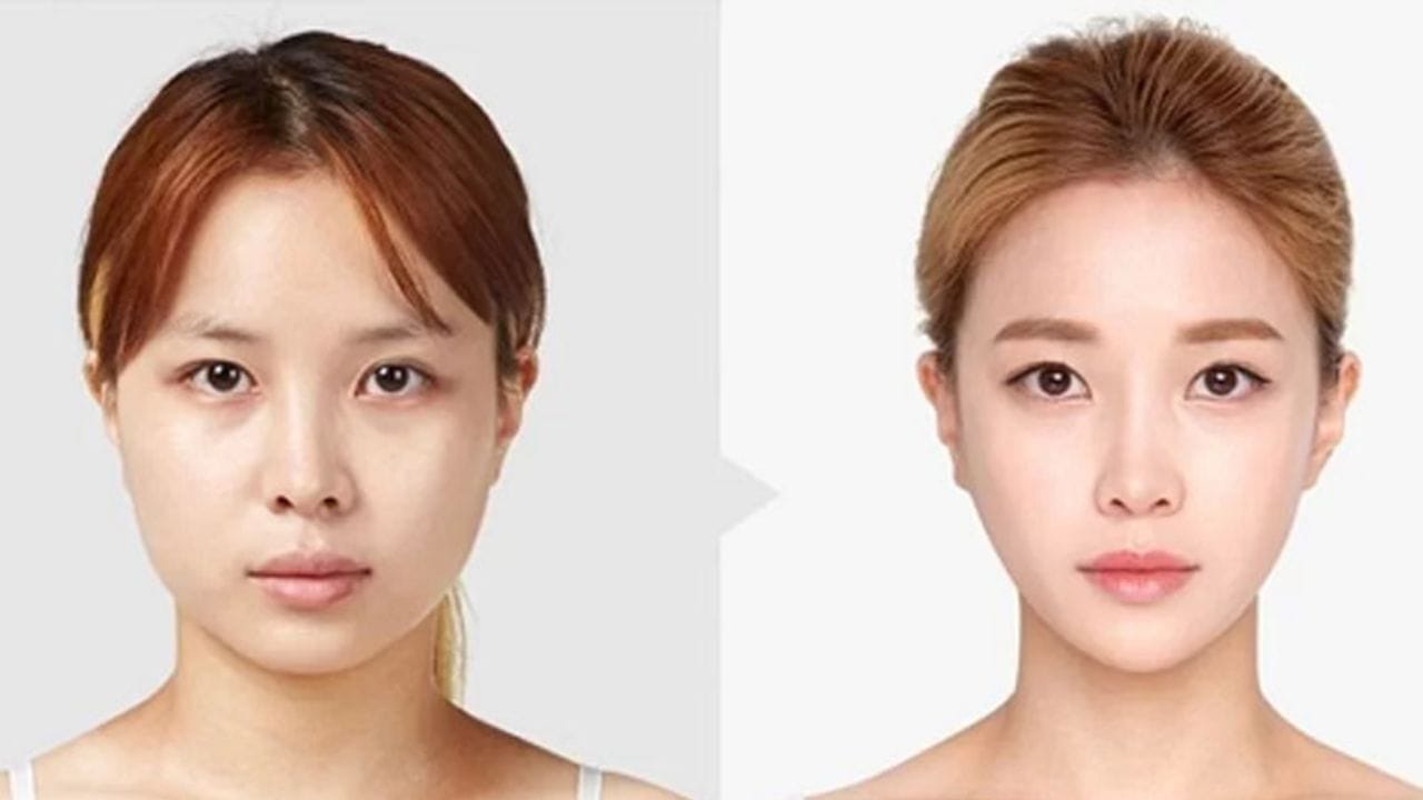 Gọt cằm có ảnh hưởng gì không? Giải đáp từ chuyên gia hàm mặt