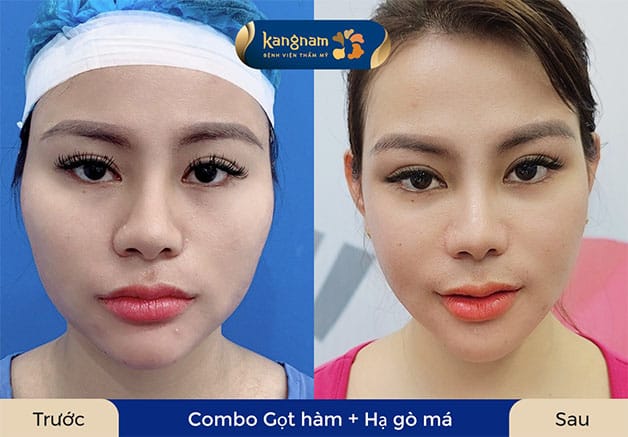 Gọt hàm nghỉ dưỡng và hồi phục sau 2 đến 3 tuần