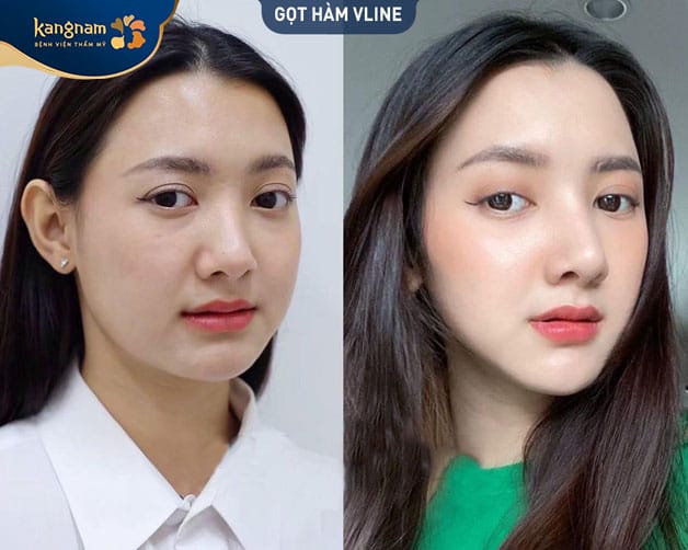 Khuôn hàm thon gọn, chuẩn tỷ lệ vàng