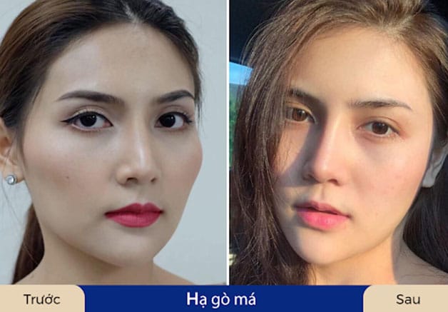 Khách hàng sở hữu gương mặt cân đối, hài hòa sau khi hạ gò má