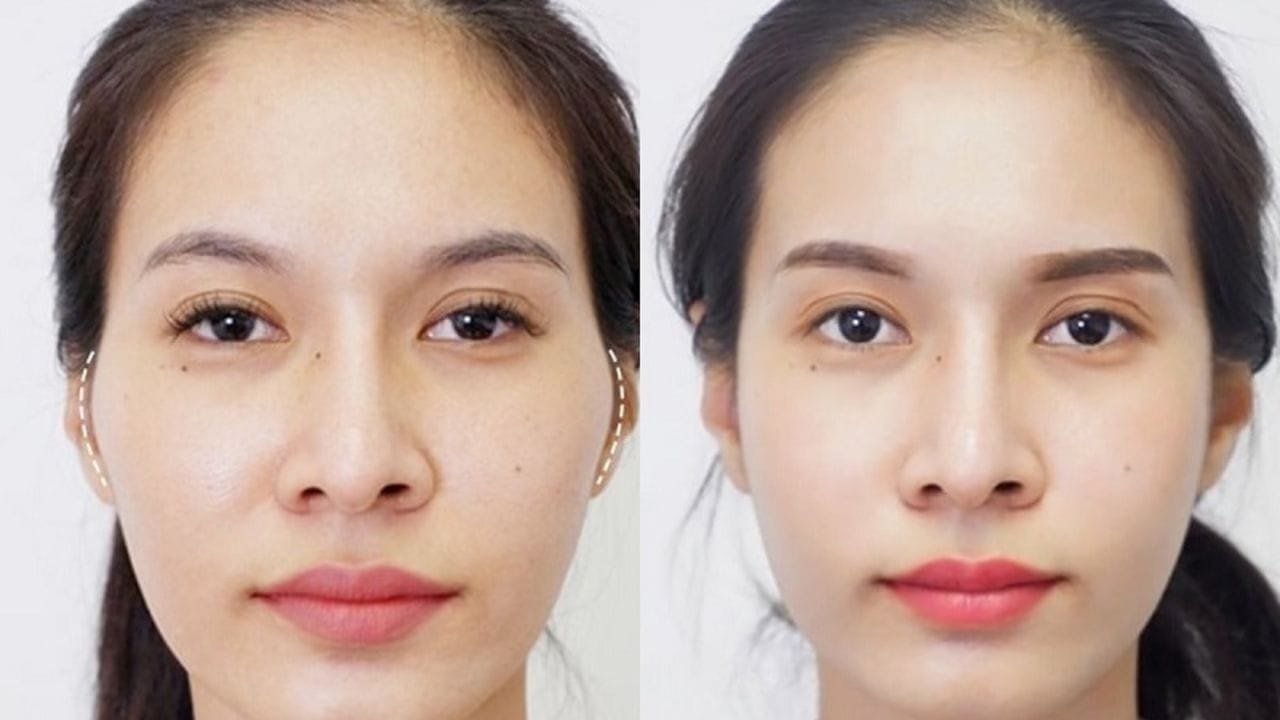 Chi phí hạ gò má bao nhiêu tiền? Bảng giá mới nhất