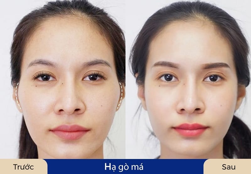 Hạ gò má có mức giá rất đa dạng