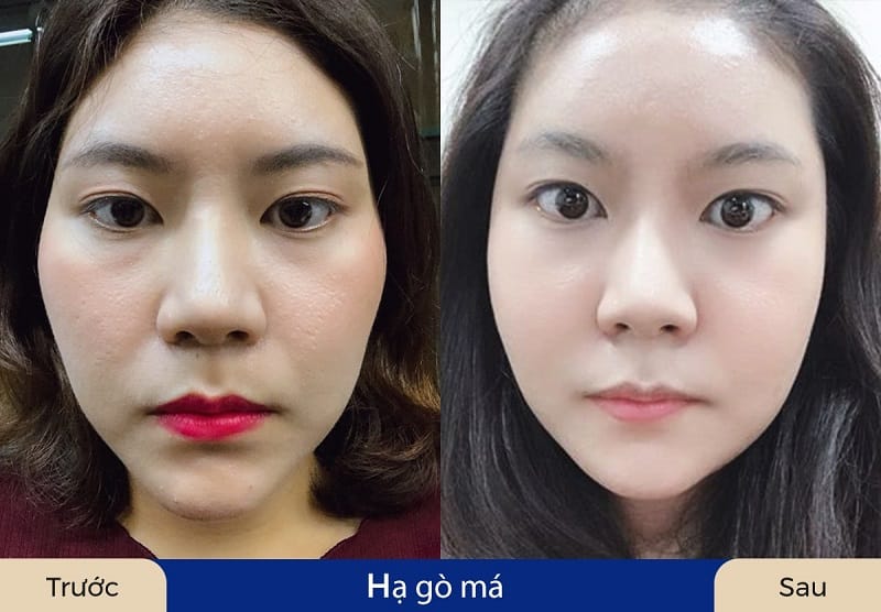 Khách hàng gặp tình trạng gò má cao, phức tạp sẽ cần kết hợp nhiều kỹ thuật khác nhau