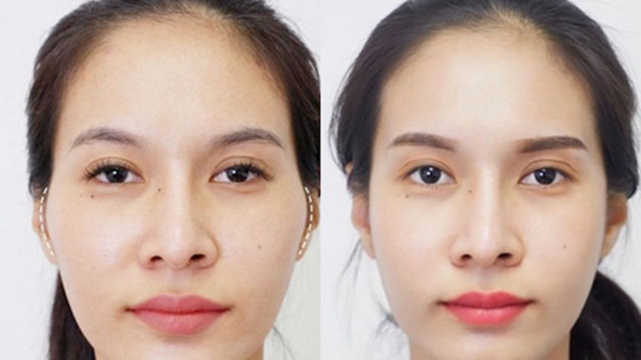 Hạ gò má có được vĩnh viễn không? cần lưu ý điều gì