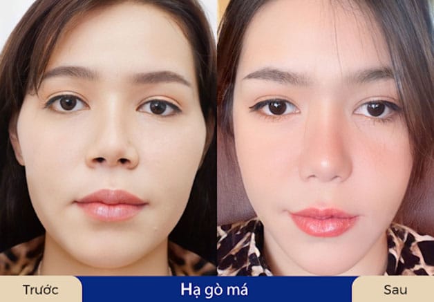 Kết quả hạ gò má sẽ ổn định sau 1 thời gian