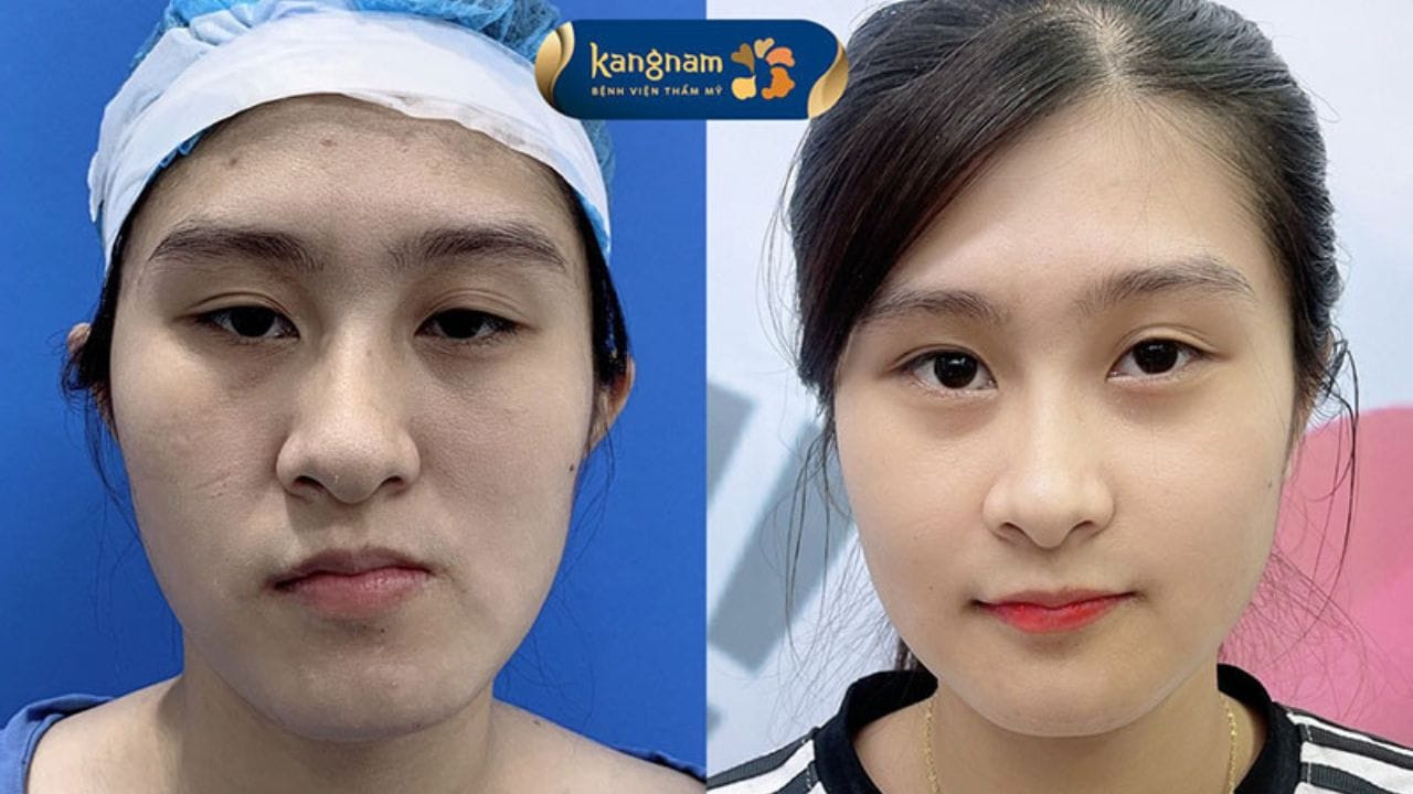 Phẫu thuật chỉnh hàm lệch giá bao nhiêu? Giá gồm những gì