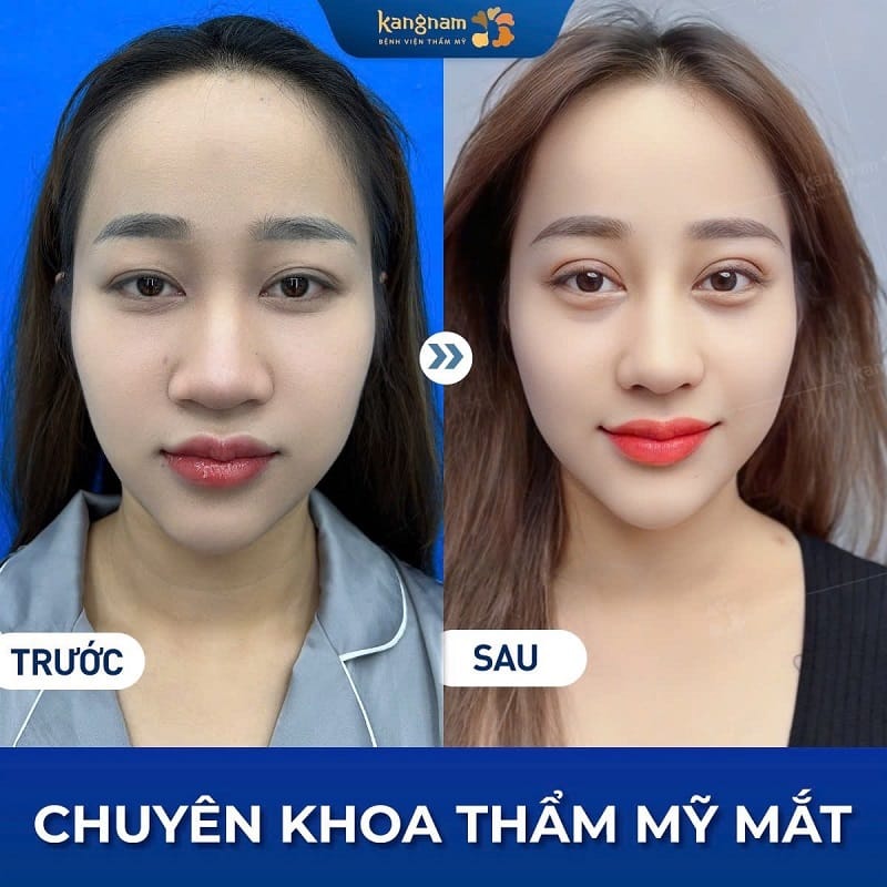 Mí mắt cân đối, hài hòa với gương mặt