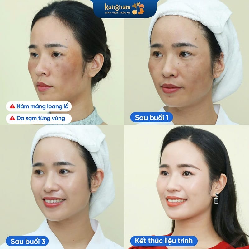 Khuôn mặt hết nám, sáng mịn