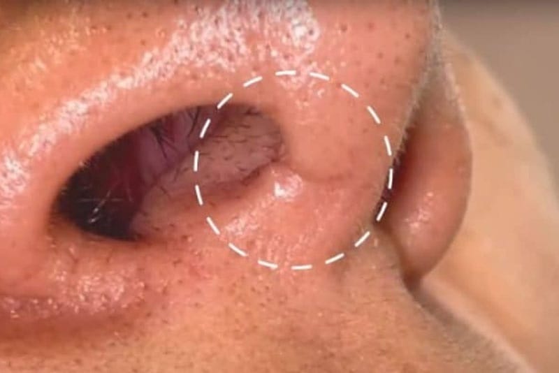 Ăn trứng quá sớm sẽ tăng nguy cơ để lại sẹo sau nâng mũi