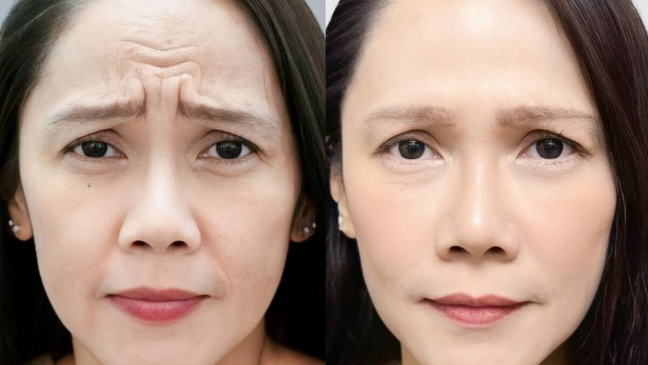 Tiêm botox xóa nhăn cau mày và những lưu ý quan trọng