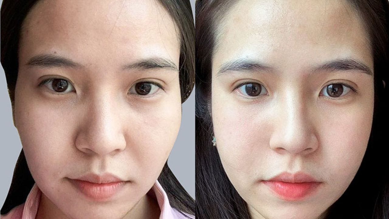 Tiêm đầy thái dương giá bao nhiêu? Bảng giá mới nhất 2025