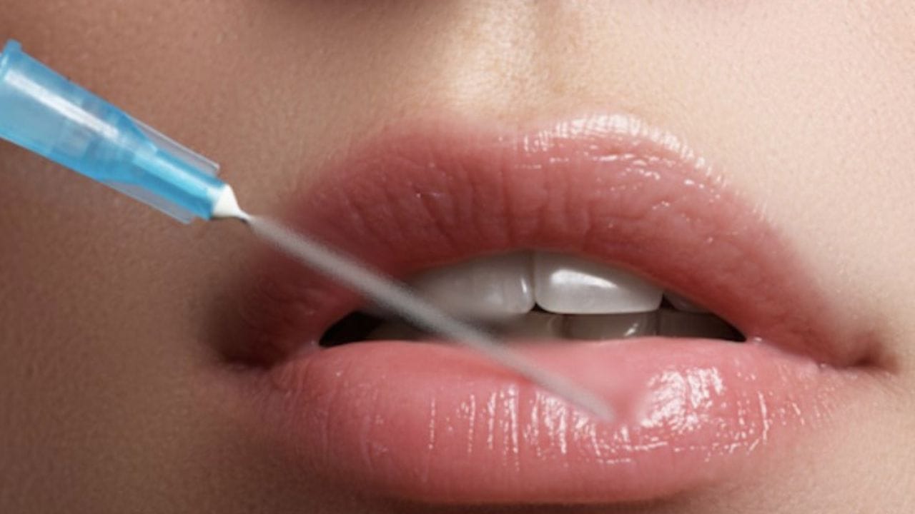 Tiêm filler môi 1cc giá bao nhiêu? Bảng giá mới nhất