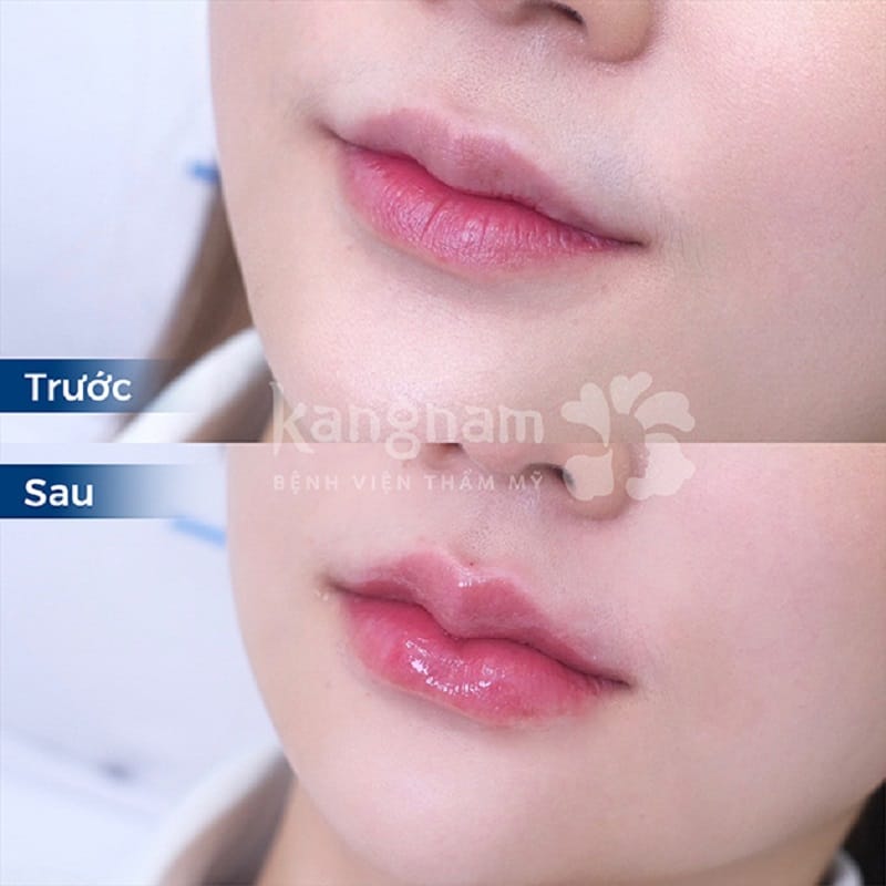 1cc tiêm filler đã giúp khách hàng sở hữu dáng môi đẹp