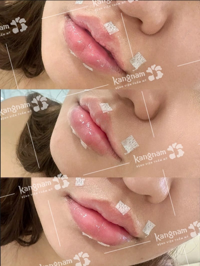 Không nên ham rẻ tiêm filler có giá thành thấp