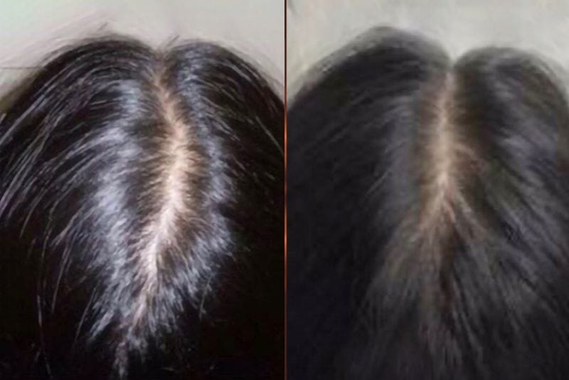 Các nang tóc bắt đầu được kích thích hoạt động sau khi tiêm meso