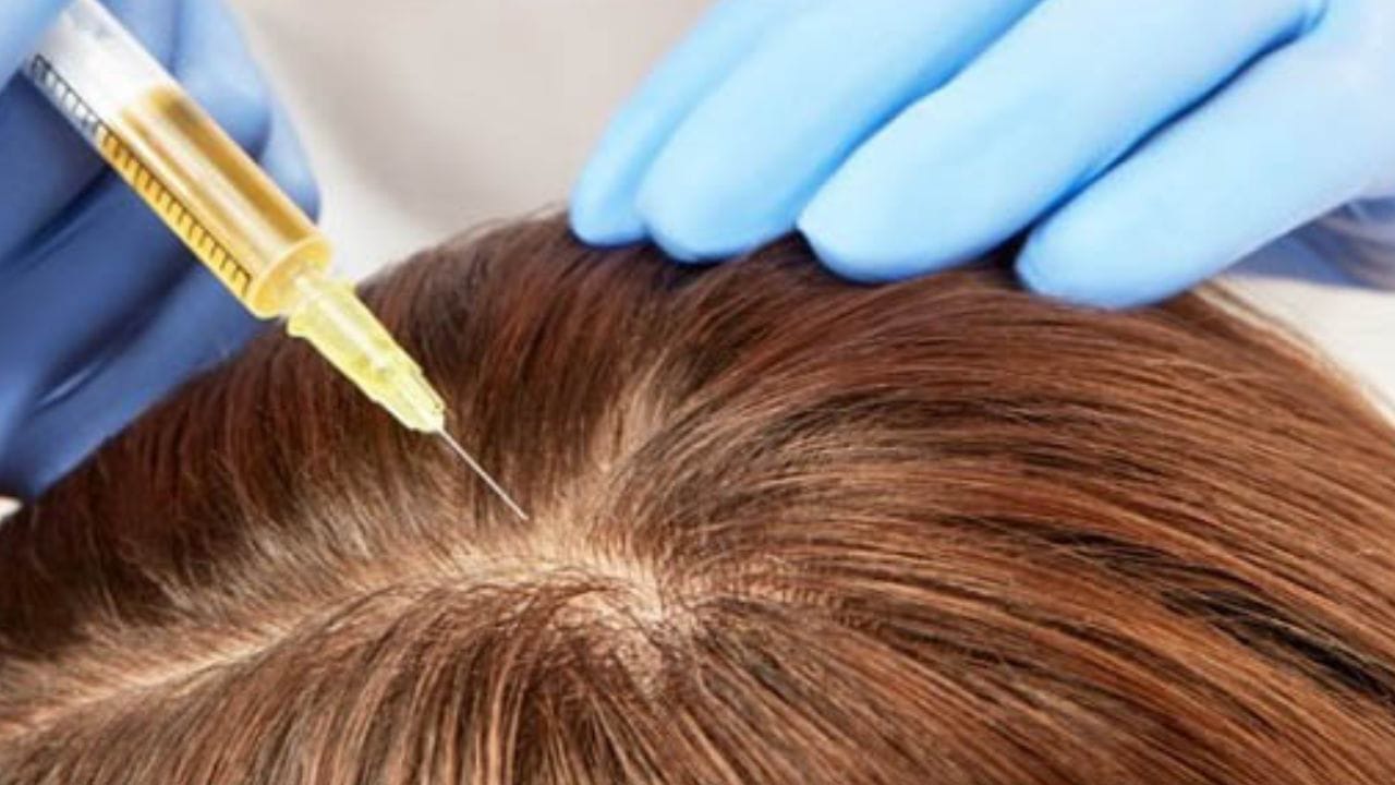 Tiêm meso mọc tóc giá bao nhiêu? bảng giá mới