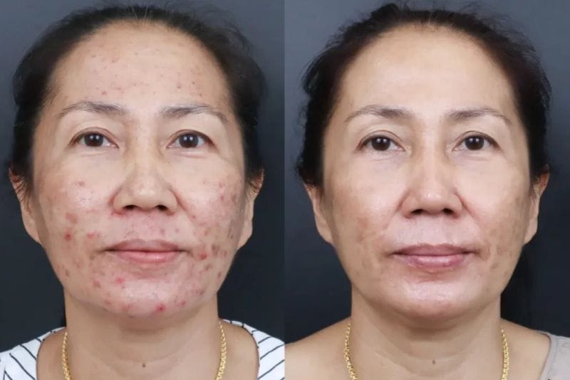 Số buổi điều trị