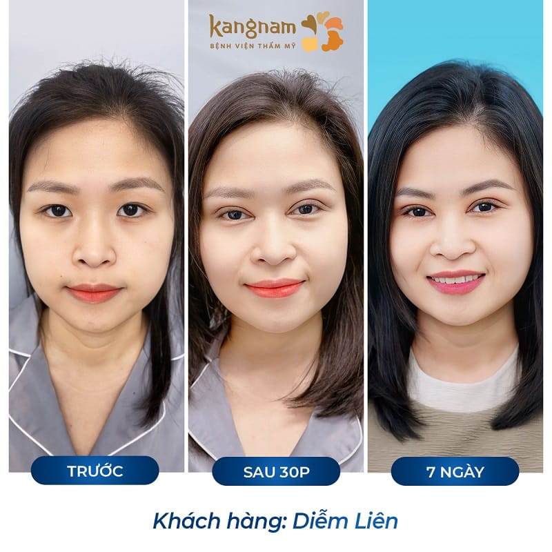 Vết thương sau cắt mí sẽ lành và ổn định sau vài ngày