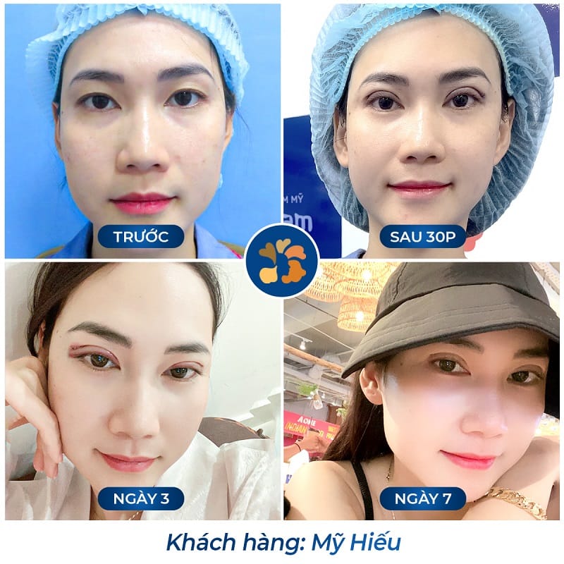 Khách hàng cắt mí tại Kangnam có thời gian hồi phục nhanh