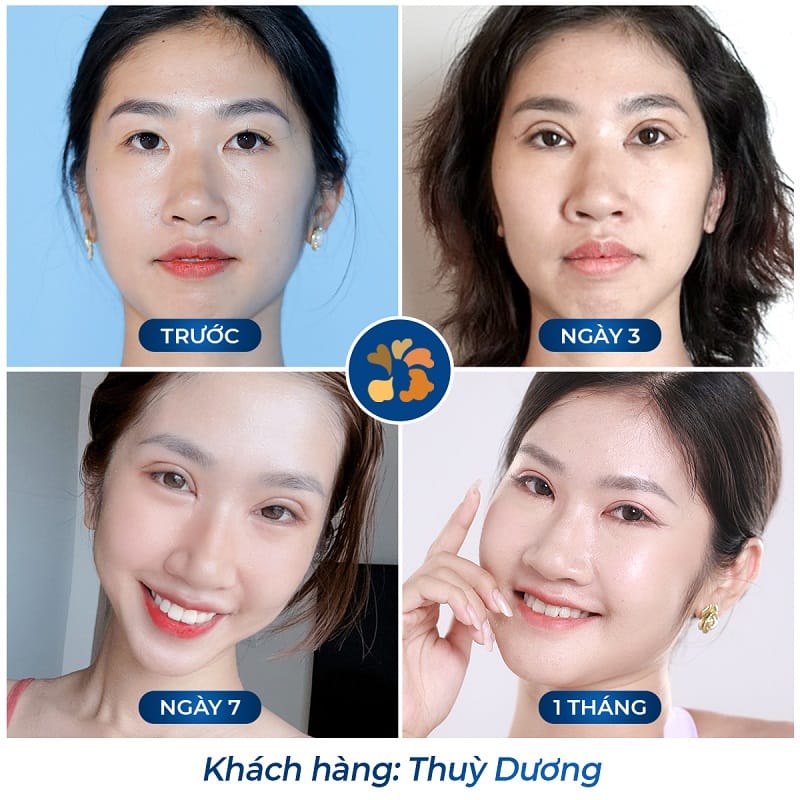 Sau 1 tháng nếp mí đã vào form