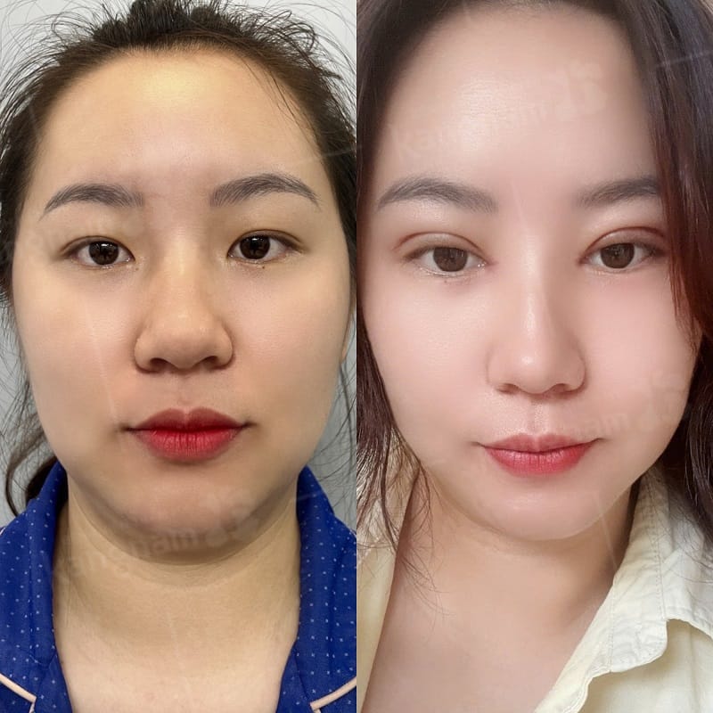 Khách hàng sở hữu đôi mắt 2 mí cân đối, tự nhiên