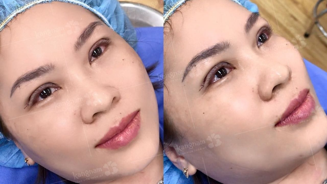 Cắt da thừa mí mắt là gì? Vì sao Việt Kiều nên thực hiện tại Việt Nam?