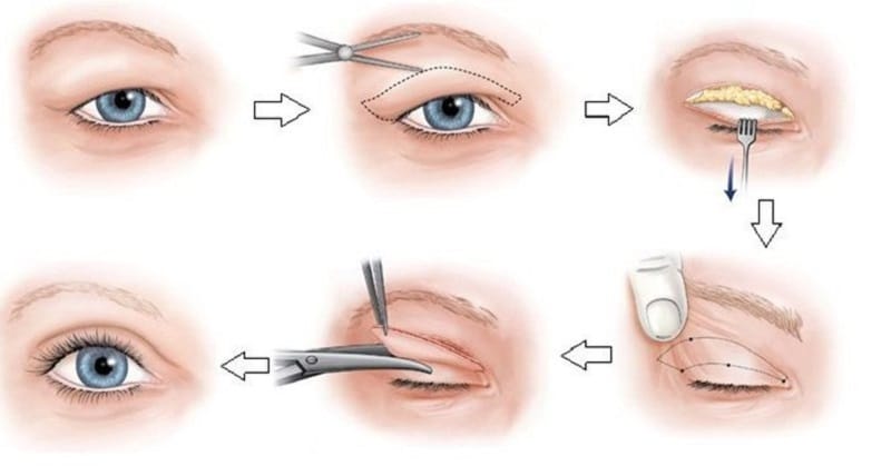 Phẫu thuật cắt da thừa, chùng nhão ở mí mắt