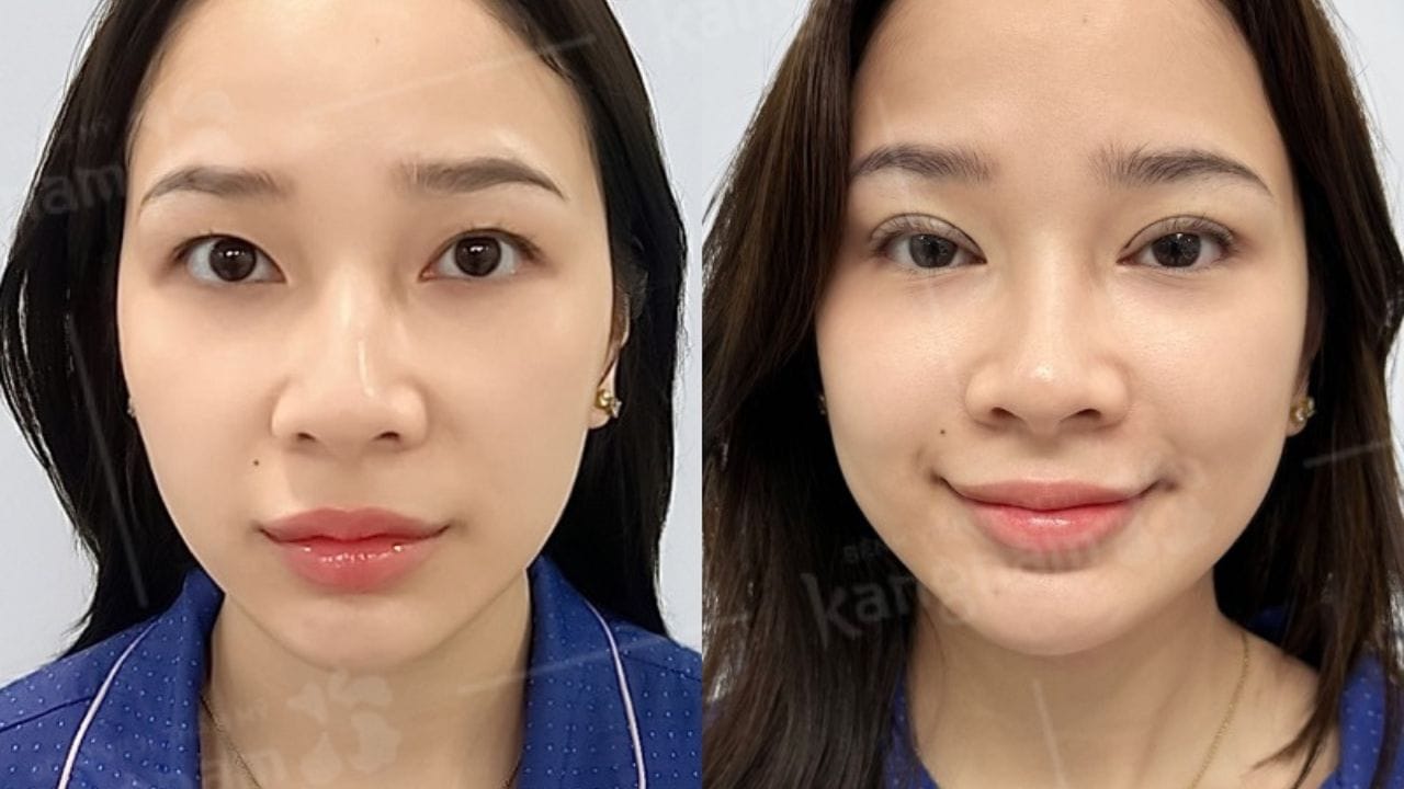 Cắt mắt 2 mí giá bao nhiêu tiền? bảng giá mới nhất