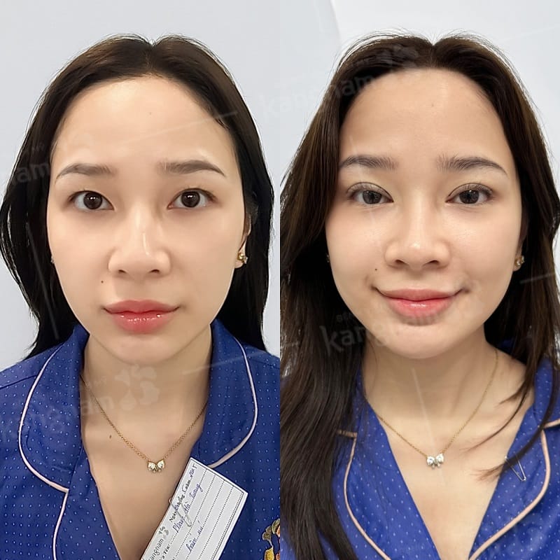 Cắt mắt hai mí có chi phí khá đa dạng