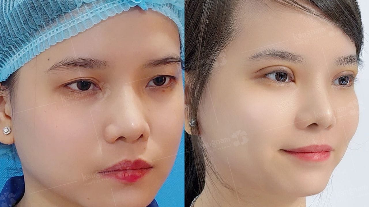 Cắt mí sau bao lâu thì đẹp tự nhiên và mềm mại