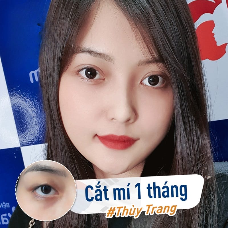 Nếp mí ổn định và đẹp tự nhiên chỉ sau 1 tháng